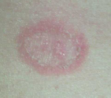 장미색비강진(장미색잔비늘증, Pityriasis rosea) - Metamedic