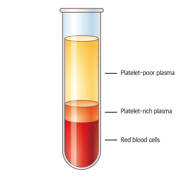 재생치료: 혈소판 풍부 혈장(Platelet-rich plasma) - Metamedic