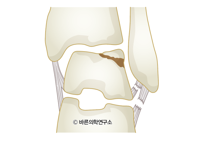 거골의 골연골 병변(골연골골절, Osteochondral lesion of talus, OLT) - Metamedic