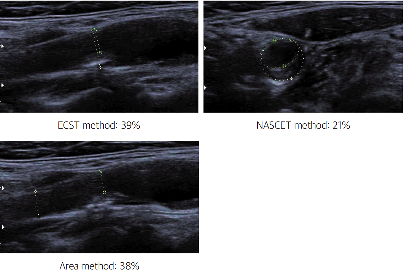 경동맥 초음파(Carotid ultrasonography) - Metamedic