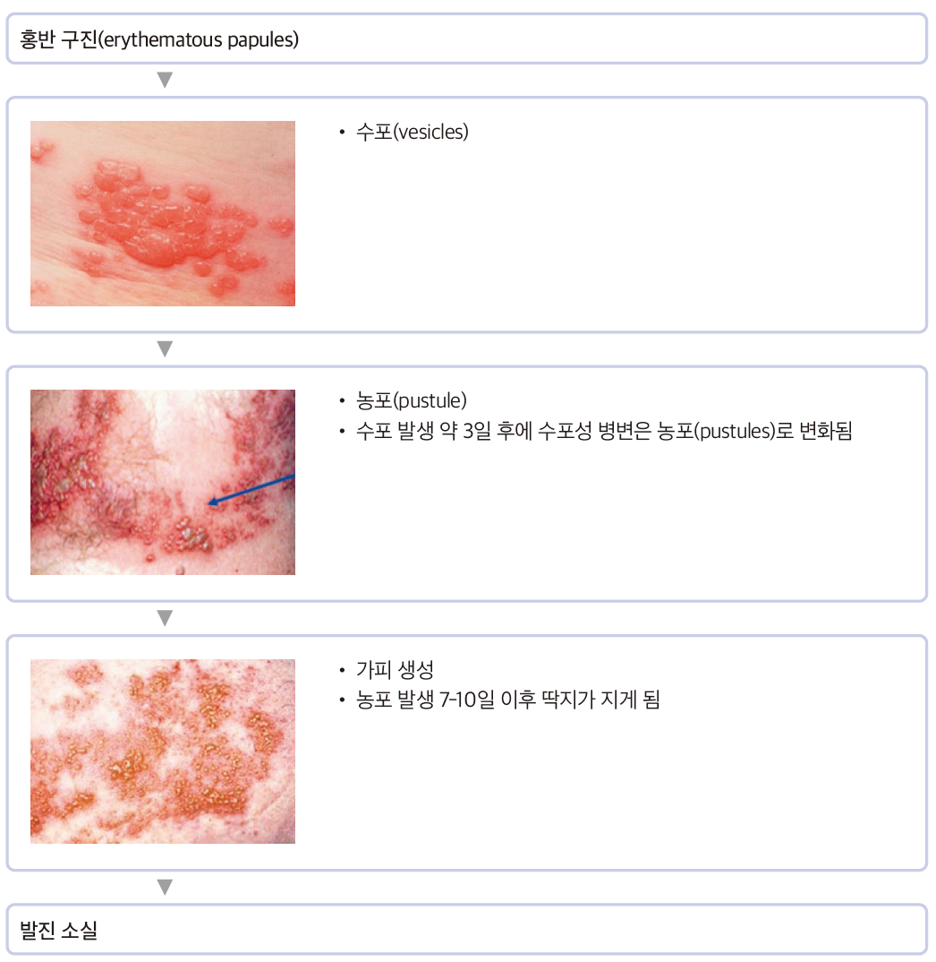 대상포진(Herpes zoster) - Metamedic