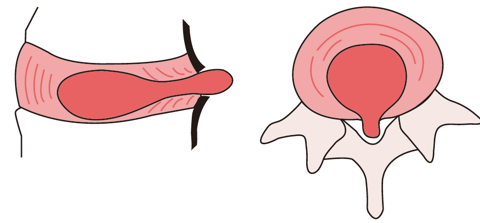 추간판탈출증(lumbar HIVD): 개요 - Metamedic