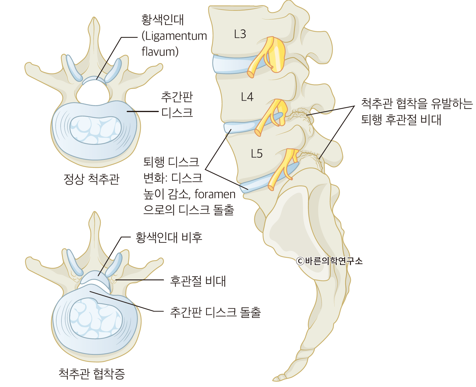 척추관협착증: 개요 - Metamedic