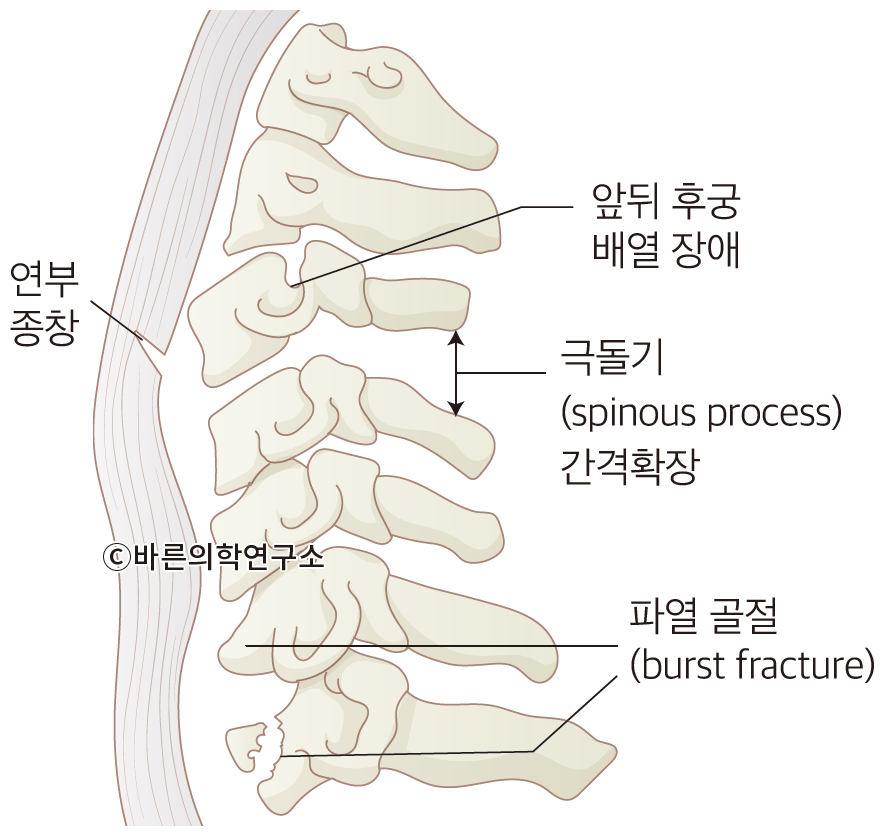 척추 외상 환자의 접근: 신경학적 검사, 척추 손상 기초 - Metamedic