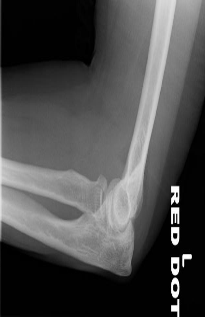 요골 두 골절(Radial head fracture) - Metamedic