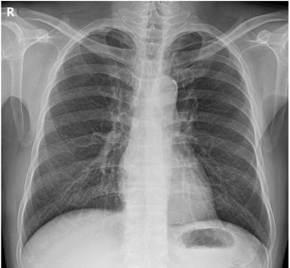 칼슘통로차단제(Calcium channel blocker)의 부작용: 말초부종(peripheral edema) - Metamedic
