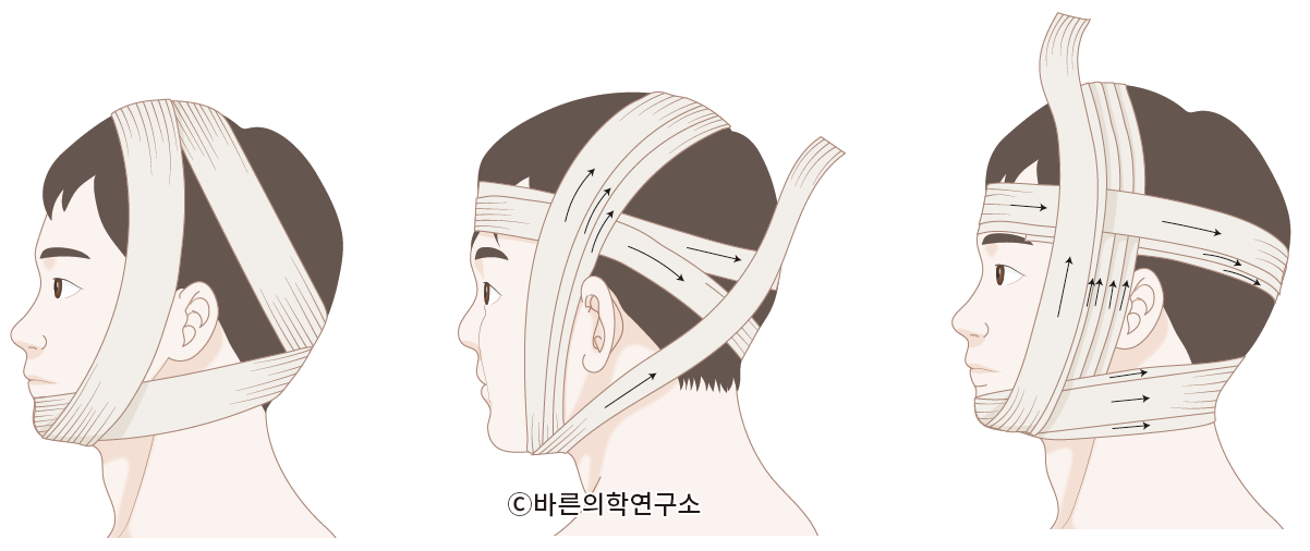 턱관절 탈구(mandible dislocation) - Metamedic