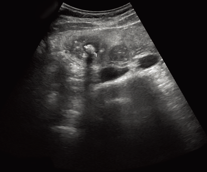 담석증(Gallstone disease) - Metamedic