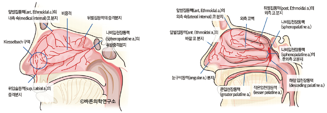 코피(Epistaxis, nosebleed) - Metamedic