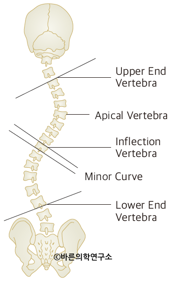 척추 측만증(Scoliosis) - Metamedic