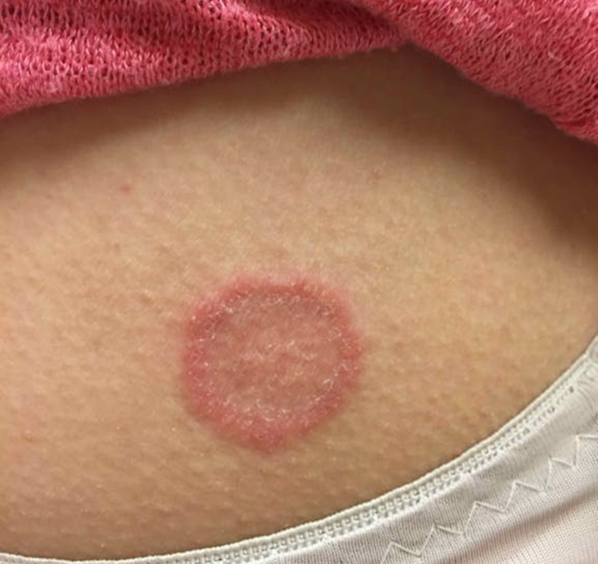 백선증(Tinea infection): 다양한 피부소견 - Metamedic