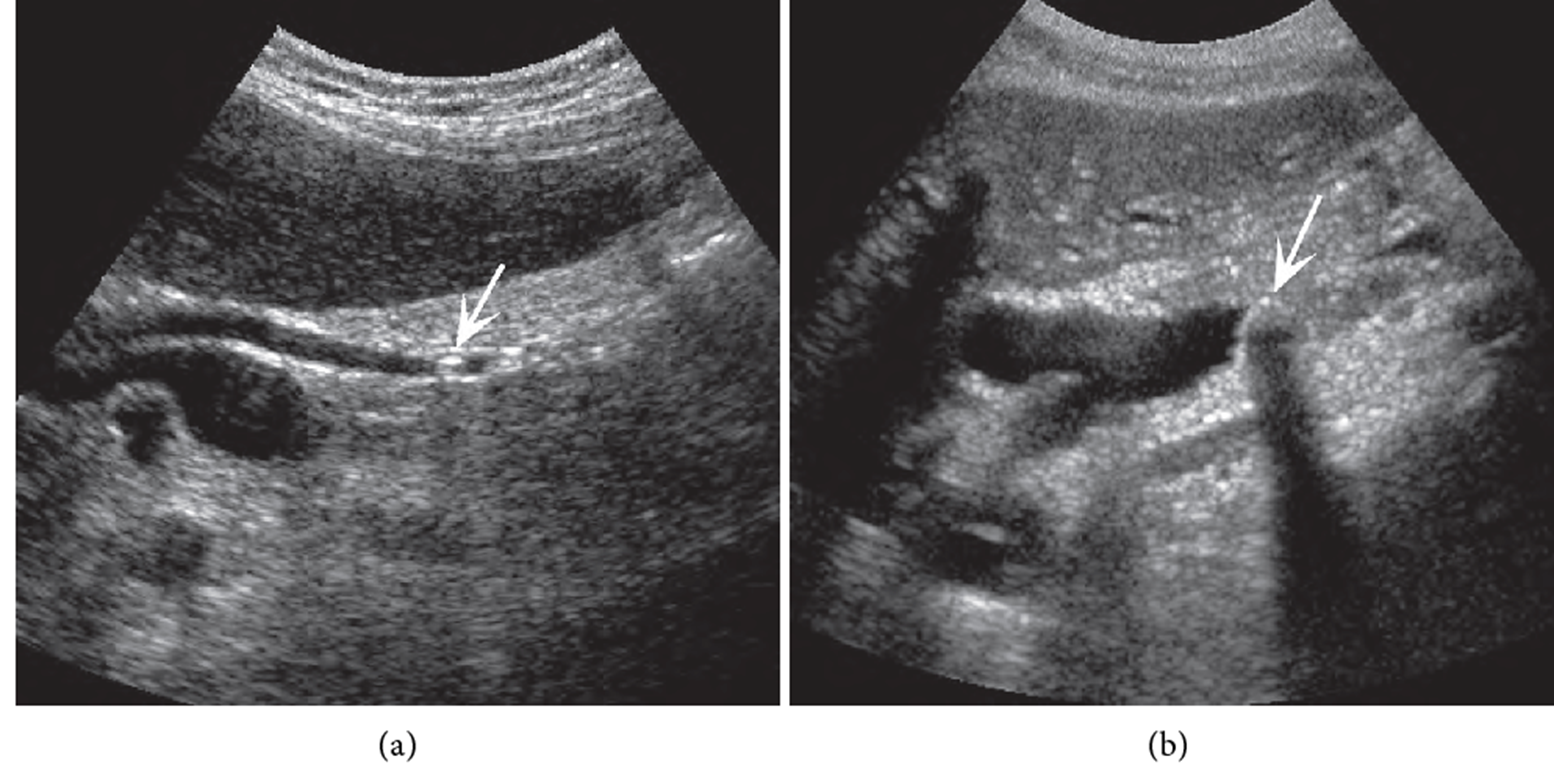 [초음파] 담낭/담도(gallbladder/bile duct): 주요 질환 (1) - Metamedic