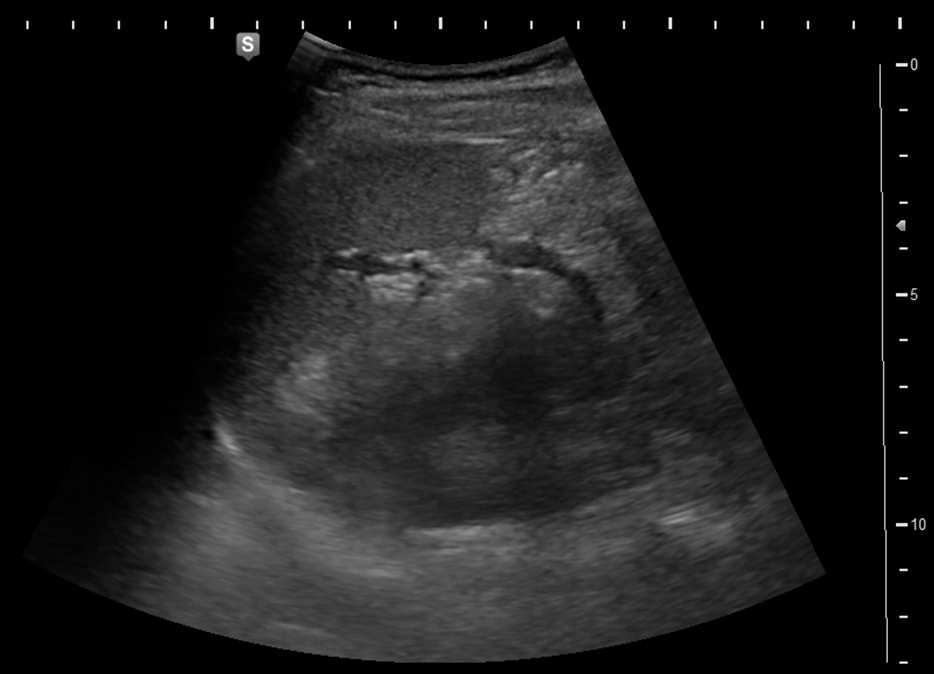[초음파] 췌장(Pancreas): 기초 - 해부학, 스캔법 - Metamedic