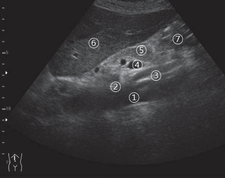 [초음파] 췌장(Pancreas): 기초 - 해부학, 스캔법 - Metamedic